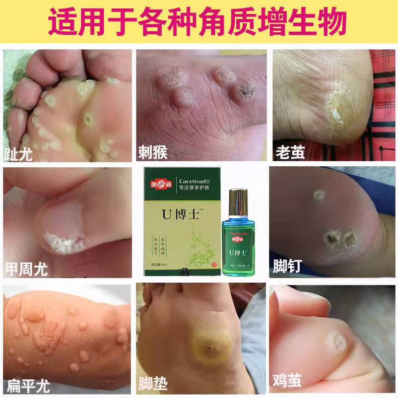 刺猴肉丝状扁平l疣刺猴去除膏脚上长猴子肉粒硬疙瘩血泡刺手部足部