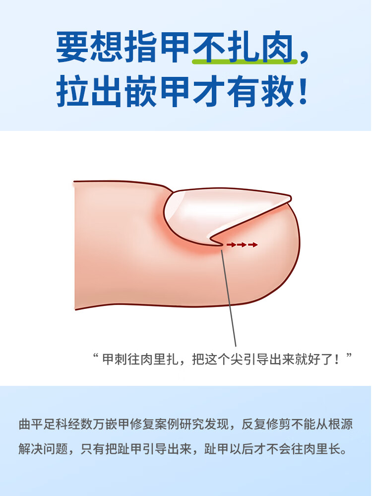 曲平甲沟器脚趾甲嵌甲指甲专用贴片正甲贴脚沟纠正贴神器炎 下单再鎹