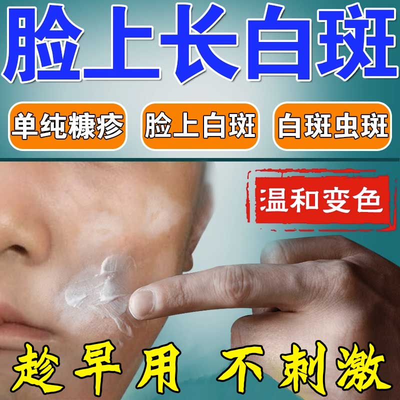 白色糠疹药膏 儿童脸上白斑 脸上小圆形白斑白藓虫斑 脸上肩部颈部长