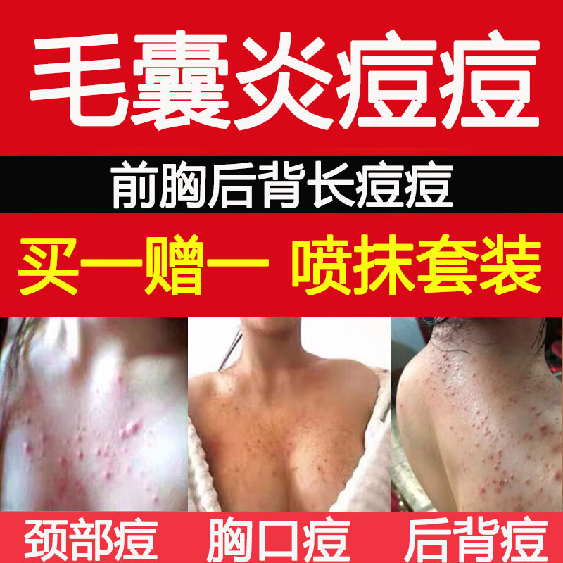 【背后和胸口长痘痘背上】毛囊炎膏背部前胸后背胸前起红疙瘩喷雾舰旗