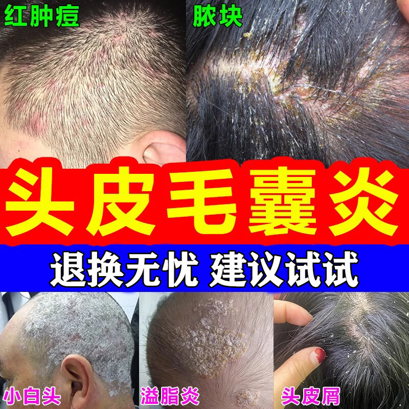 毛囊i炎头皮痒脂溢性皮炎洗发水治疗头部头皮痒有疙瘩的药头皮癣银屑