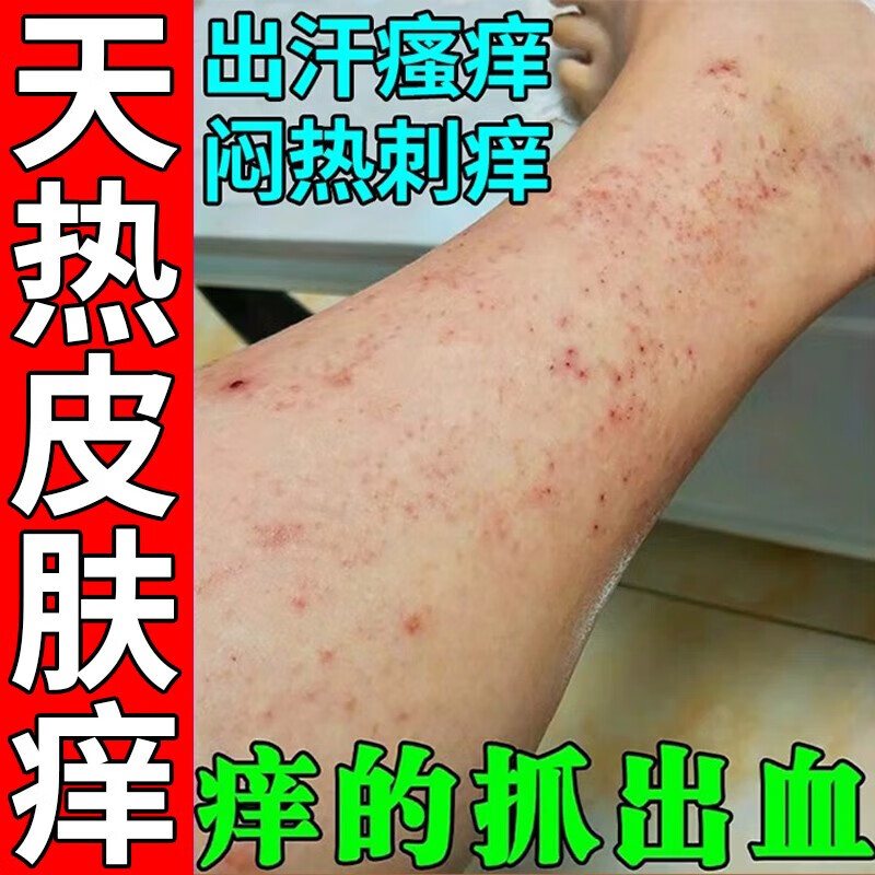 默莹 moeulyane庐太医天气热皮肤瘙痒腿痒小腿皮肤痒身上起红疙瘩长红