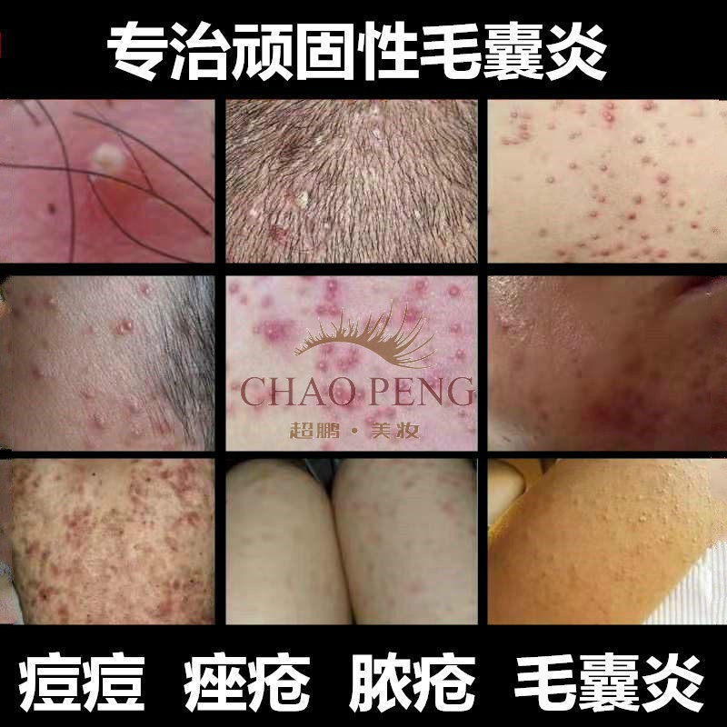 头皮毛囊炎薬膏头上长痘痘头部背部脓包疙瘩痤l疮膏皮肤l病薬膏 一盒