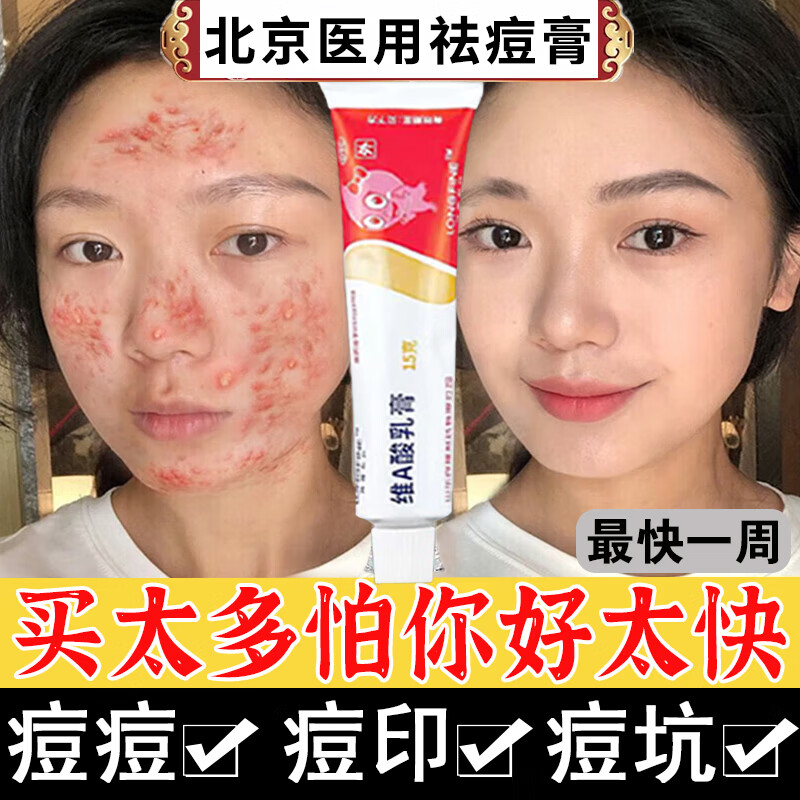 痤疮膏 祛痘 脓疱疮 毛囊炎 青春痘脸上螨虫 维a酸乳膏 一盒
