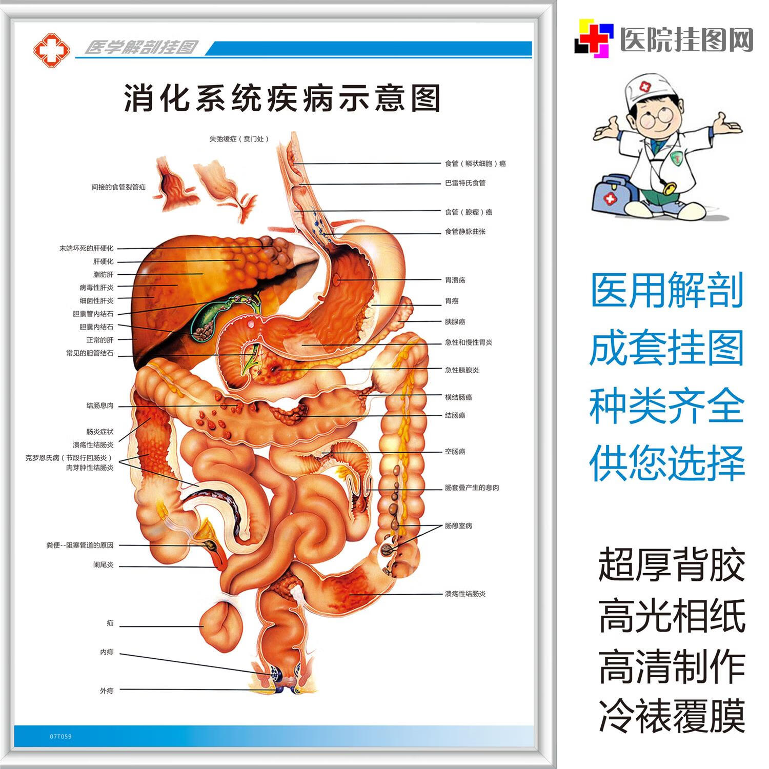 系列解剖挂图疾病食管胃胆道大肠海报定制相纸pp胶 消化疾病示意图 24