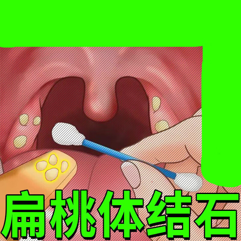 清倍康药房直售扁桃体结石咽喉异物感肿口臭喷剂 单盒装