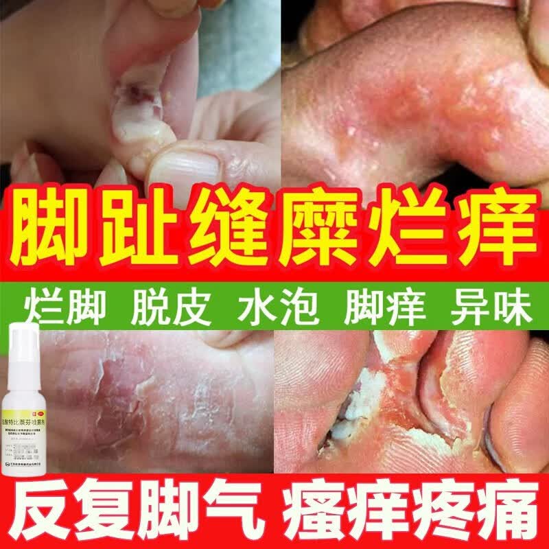 脚气药止痒脱皮烂脚丫真菌感染止痒脚趾缝溃烂脚气脚臭