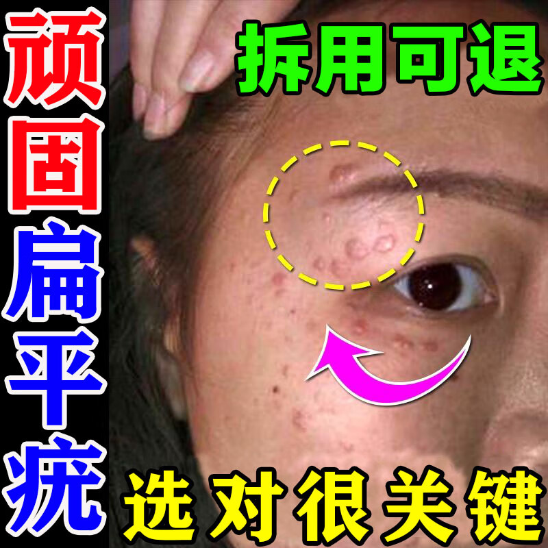 扁平疣专用i药去疣灵克疣软膏身体面部脖子去肉粒去疣瘊子丘疹丝 单盒