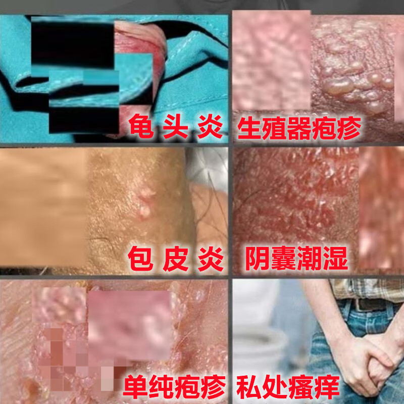 【京健康】淋病显性梅毒龟头炎尿道口流脓炎男女性病一扫光喷剂
