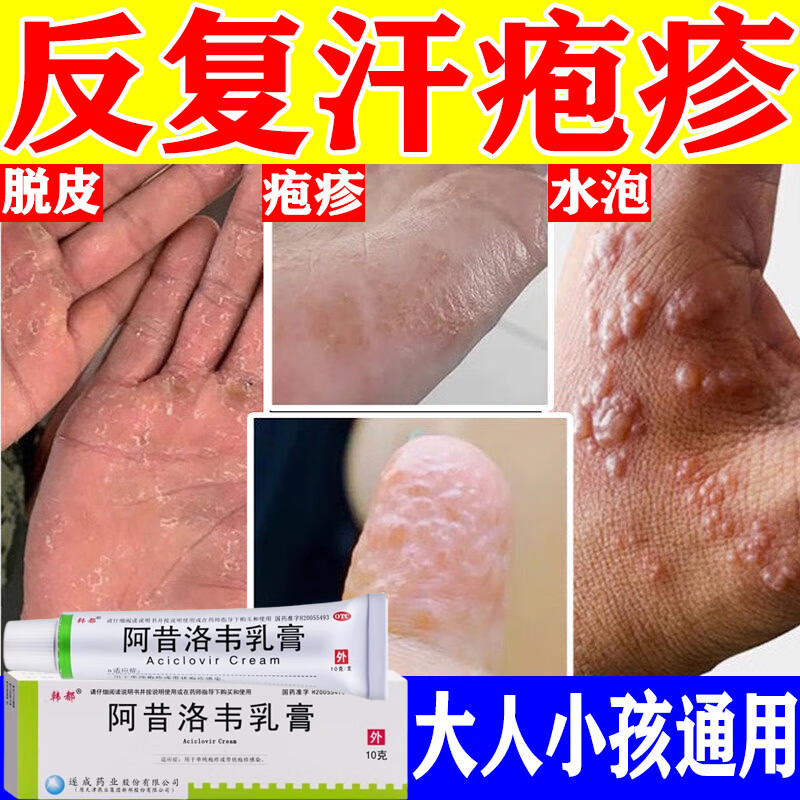 起小水泡专用膏脱皮手痒真菌感染消炎止痒膏疱疹抑制真菌感染皮肤外用