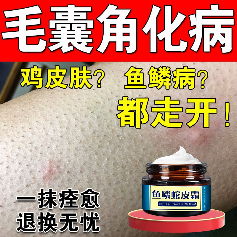 鸡皮肤春天会痒吗(一到冬天就有鸡皮肤特别痒) 鸡皮肤春天会痒吗(一到冬天就有鸡皮肤特别痒)