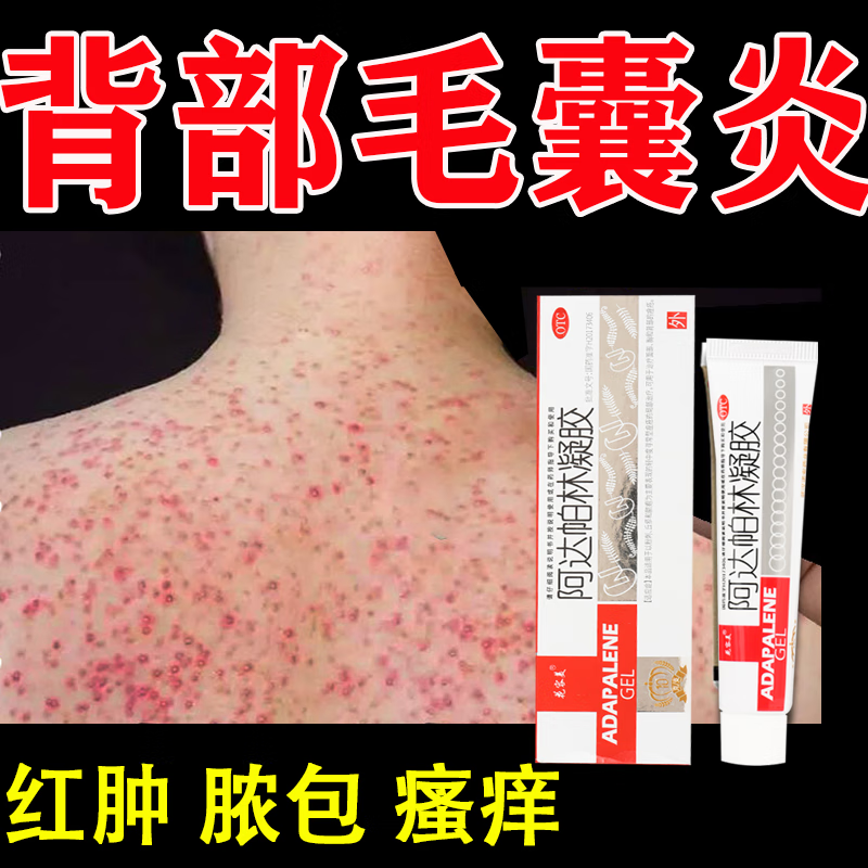 阿达帕林凝胶 毛囊炎药膏阿帕达凝胶】毛囊炎药专用otc药后背鸡皮疙瘩