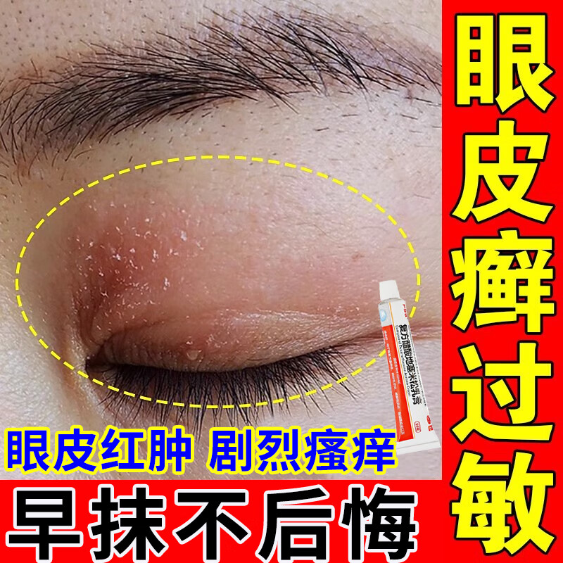 眼皮癣 眼皮红肿痒 过敏干燥麦粒肿眼周过敏眼角瘙痒起皮有碎屑 眼皮