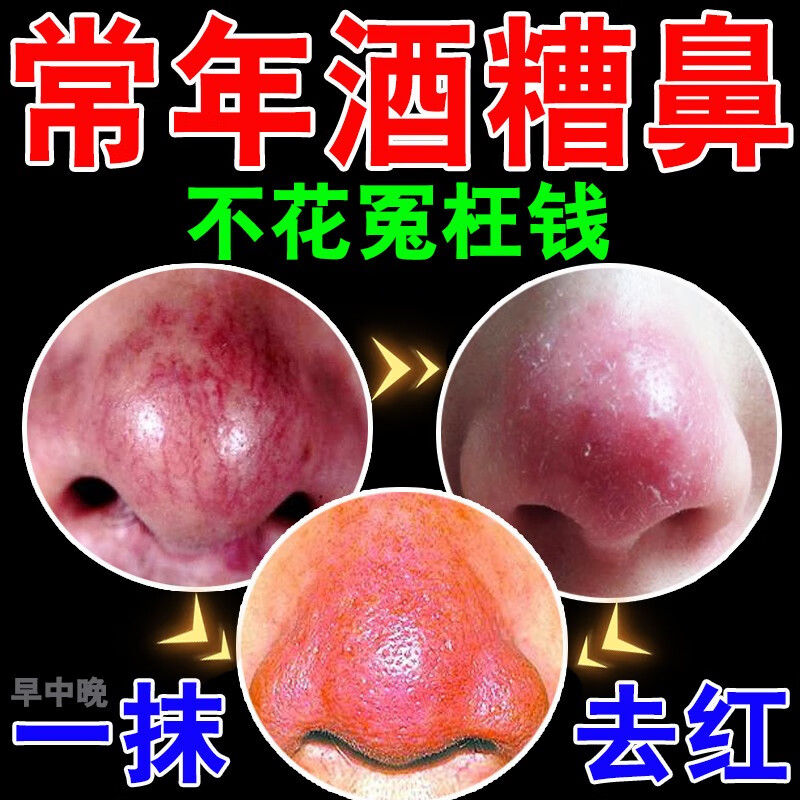 酒糟鼻专修复喝酒后鼻子红肿脓包上火疙瘩草莓鼻去黑头粉刺红鼻 红色