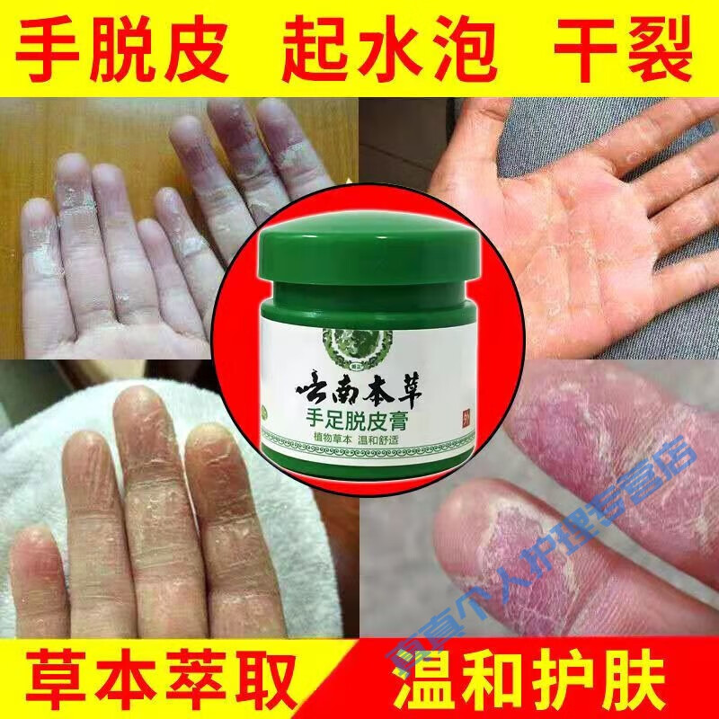 白羌笛手脱皮季节性手指脱皮膏真菌感染开裂手上起皮干燥蜕皮修护霜