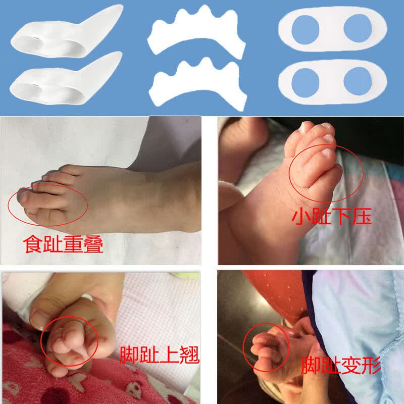 婴幼儿脚趾器儿童脚拇指外翻器重叠趾分趾器分离器可穿鞋 【6只日夜用