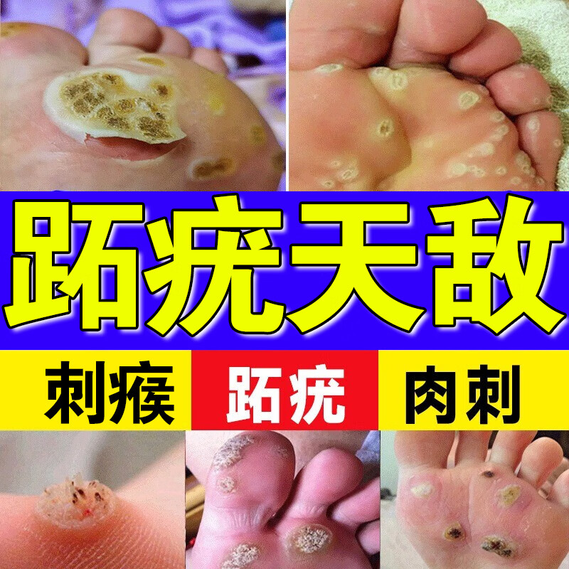 跖疣专用膏l药脚底趾疣去根去足部脚手部跖疣脚垫老茧鸡瘊刺肉猴瘊