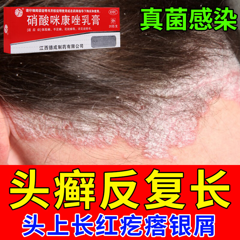 硝酸咪康唑乳膏 头癣药头癣膏引起头皮癣脂溢性皮炎银屑头皮屑头上长