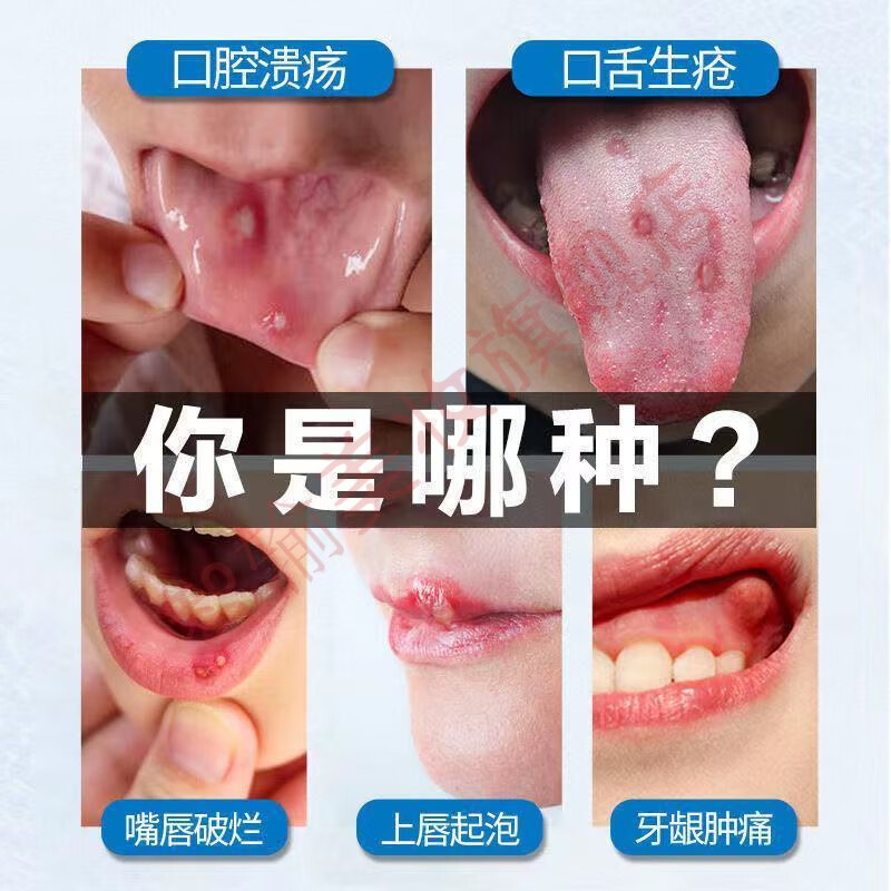 【一夜不见】口腔白色念珠菌感染上额红肿疼痛糜烂黏膜白斑液口腔护理