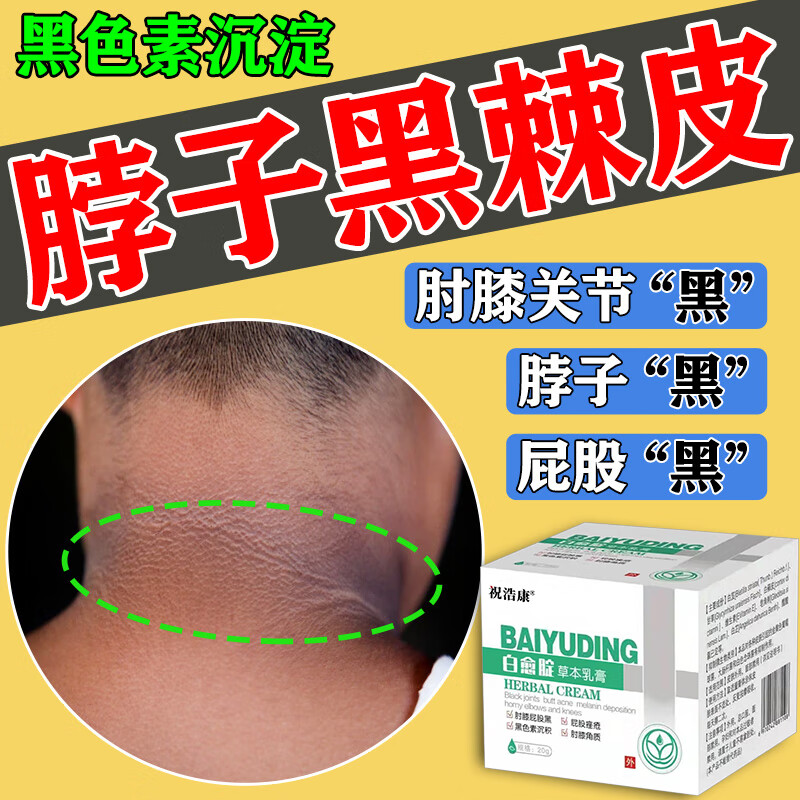 黑棘皮病脖子黑色素药膏黑棘皮病脖子黑黑的去黑色素沉淀症去除洗不