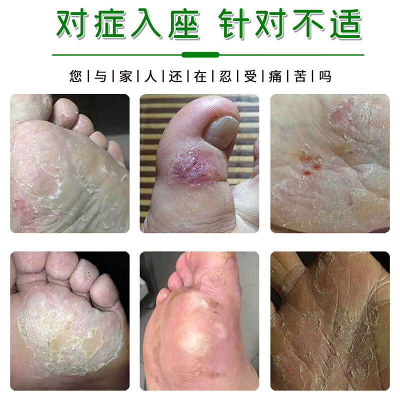 止痒快克30g皮肤瘙痒脱皮干裂水肿止痒膏过敏外用草本乳膏 50g/瓶