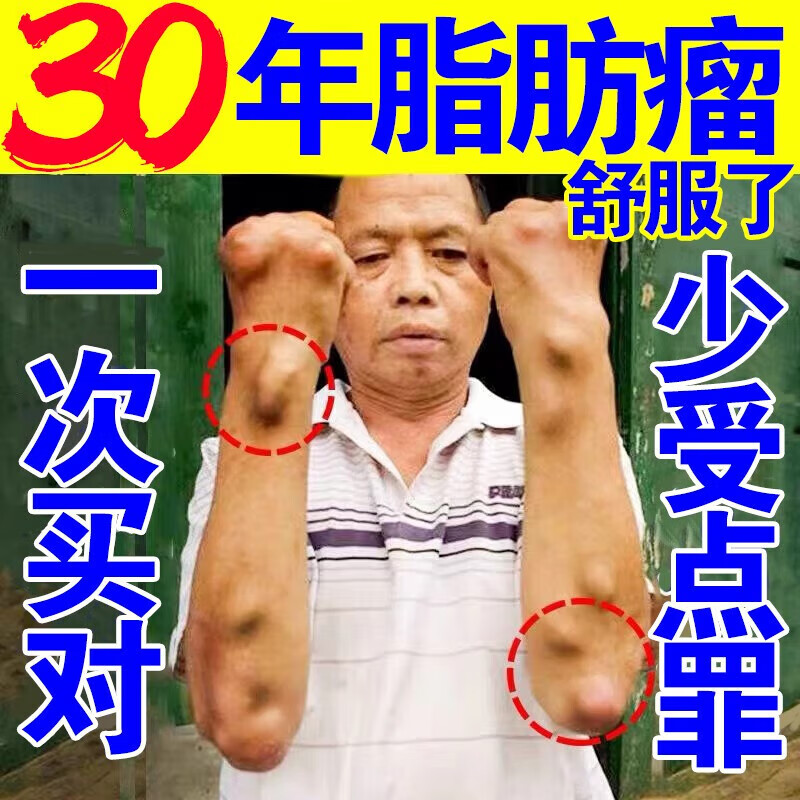 【医疗器械】脂肪瘤专用贴药3天消专消36种皮下多发性脂克星去除 单