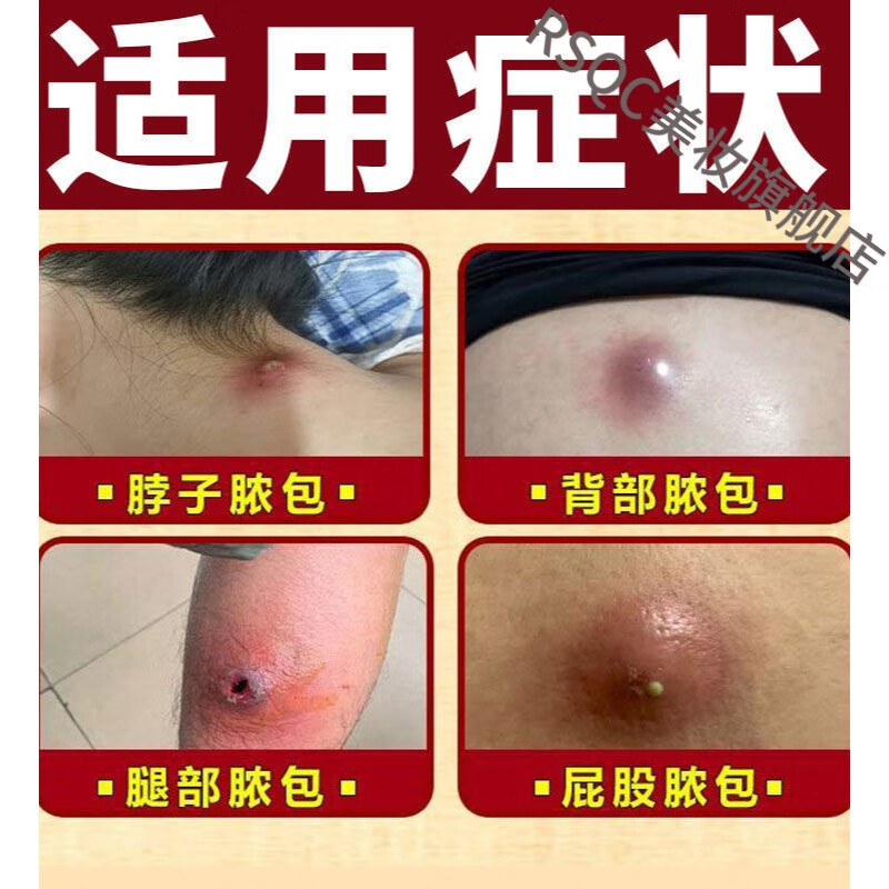 真品治火疖子拔l毒软膏箹贴疙瘩脓包红肿大肿硬块毛囊闷头吸脓訷器 一