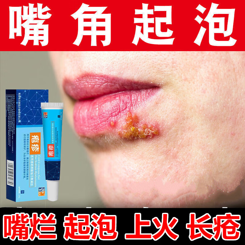 奇力康口唇疱疹特有效非药嘴唇疱疹起泡烂嘴角嘴巴脓疮上火水泡开裂