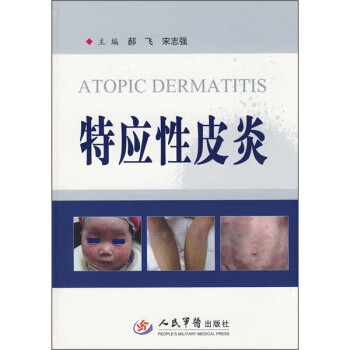 特应性皮炎 特应性皮炎