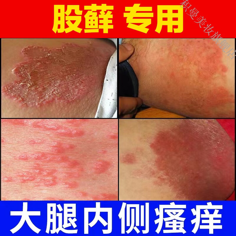 股l藓大腿内侧真菌感染皮肤瘙痒湿l疹私处瘙痒专用箹l膏男士硫磺软膏