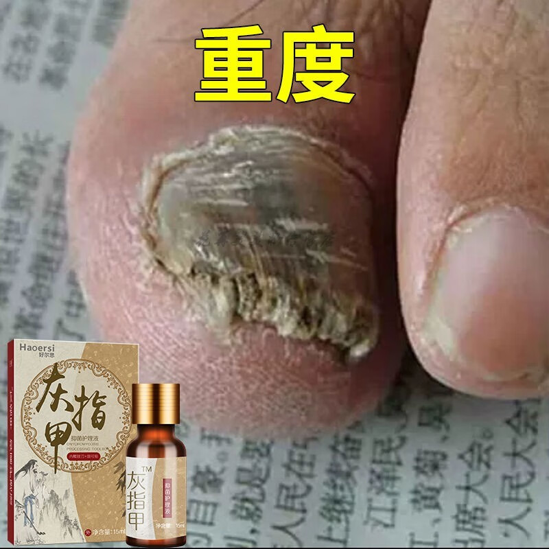【脱灰甲】灰指甲专用护理液软甲膏去i除灰指甲 【重度】软甲液2 抗菌