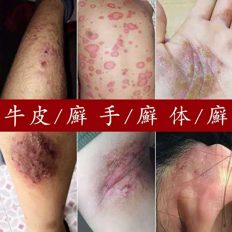 癣王喷剂去除手足体癣膏大腿内侧瘙痒真菌感染止痒膏皮肤外用癣喷剂牛