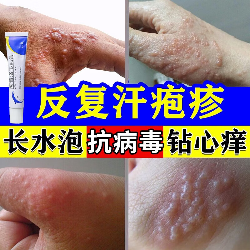 汗疱疹药膏 汗泡疹手上起长小水泡疱手痒湿疹脱皮手疙瘩气干裂汗疹