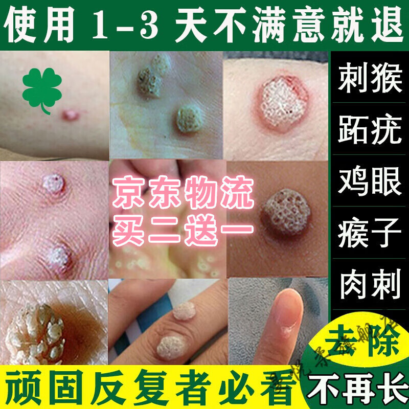 去x疣灵去猴子去净刺猴专用去chu根足部脚底手部神器疣灵