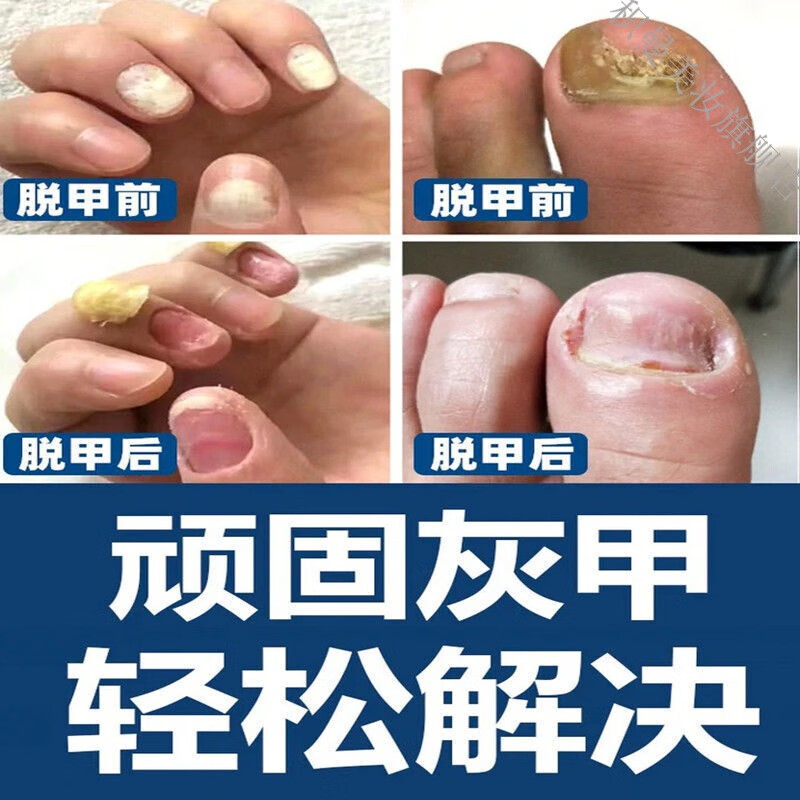 【15分钟掉坏甲】特l效抑菌液灰指甲专用液去除增厚脱甲膏甲l沟l炎 脱