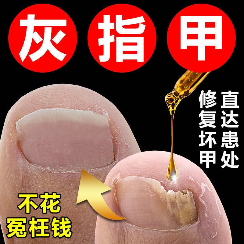 去除灰指甲专用特效抑菌液去除灰趾甲抑菌清灰甲专用修复液膏甲沟炎灰指甲套盒 去灰指甲专用液