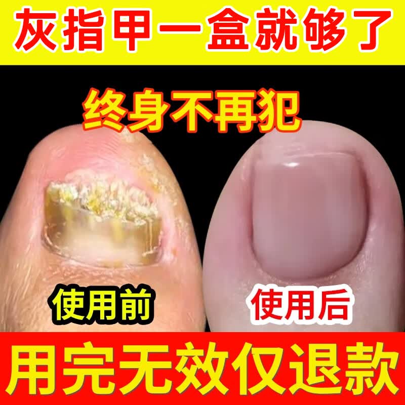 HJZZ南京同仁堂灰指甲特大效抑菌液抑菌膏发黄变厚甲特专用护甲液30ml高性价比高么？