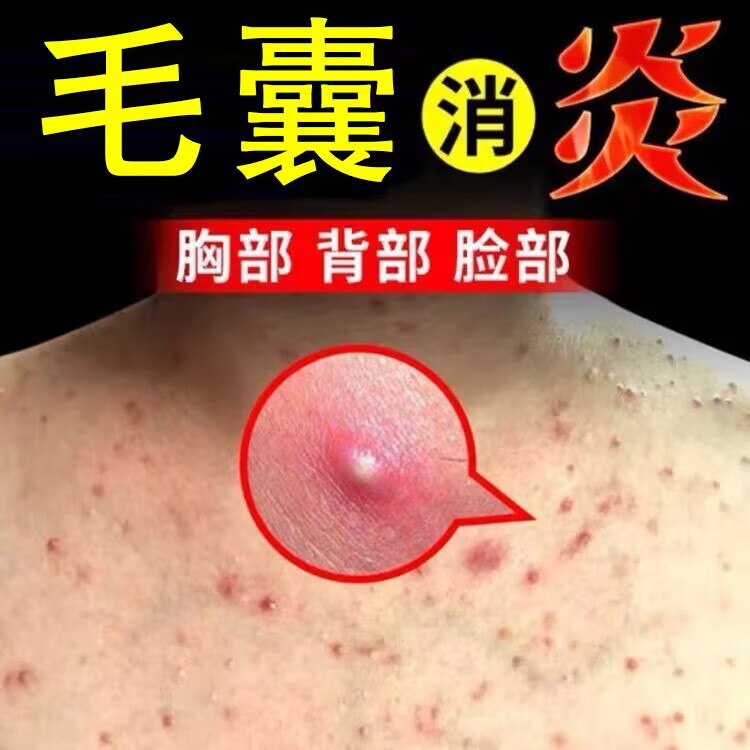 御笑堂湿l疹痒膏湿毒清急慢性皮l炎皮肤瘙痒阴囊大腿内侧湿痒红l疹膏