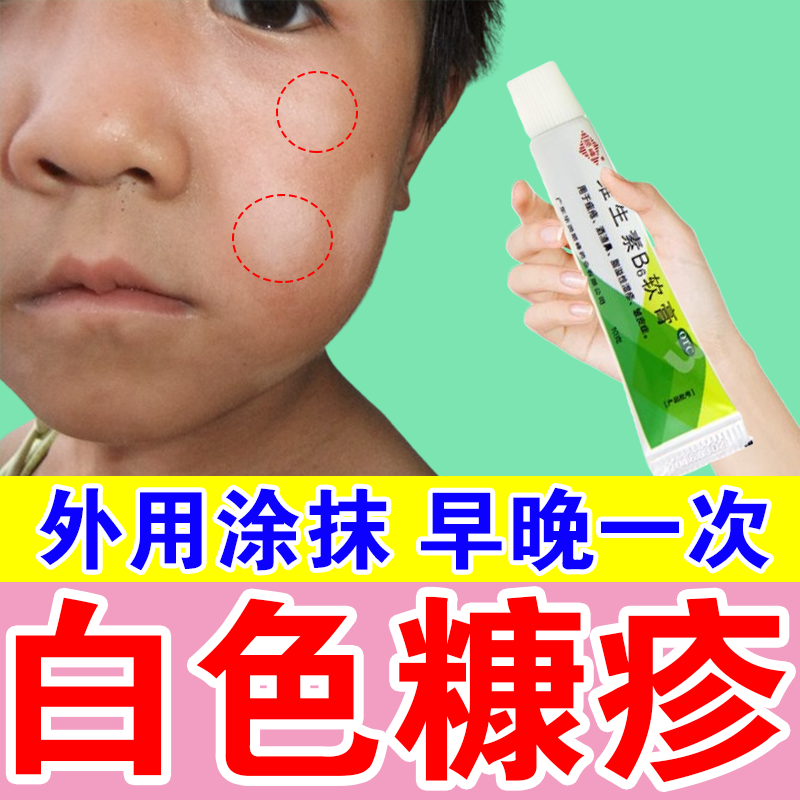 白色糠疹儿童用脸上白斑 脸上小圆形白斑白藓虫斑桃花癣 脸上肩部颈部
