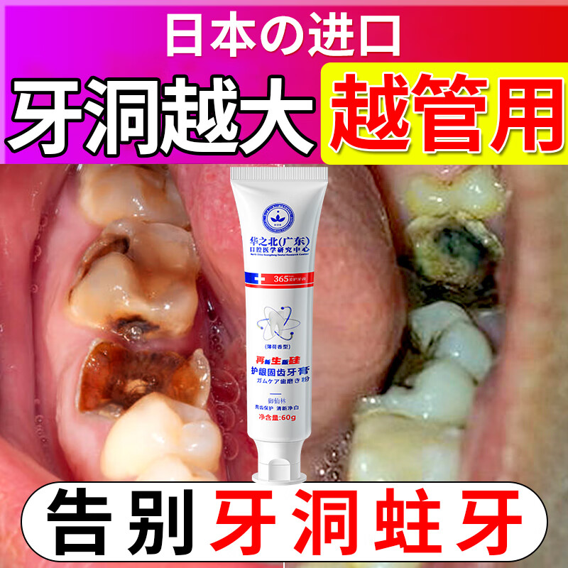 【药房直售】牙洞填充剂 补牙齿洞膏补牙缝蛀牙齿修复牙洞自己清理