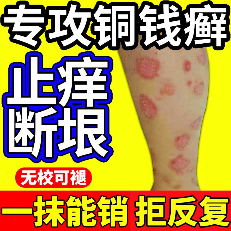 药房直售 铜钱癣膏i药外用皮肤瘙痒头癣手癣足癣体癣花斑癣股癣真 单