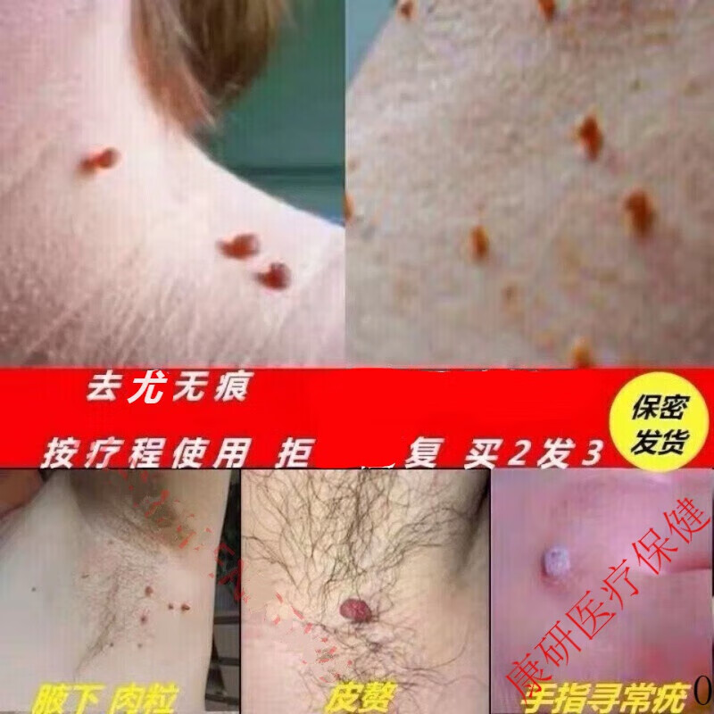 克尤净疣立净疣体脖子颈部腋下肉粒去除1疙瘩疣瘊净去尤液扁平克忧净