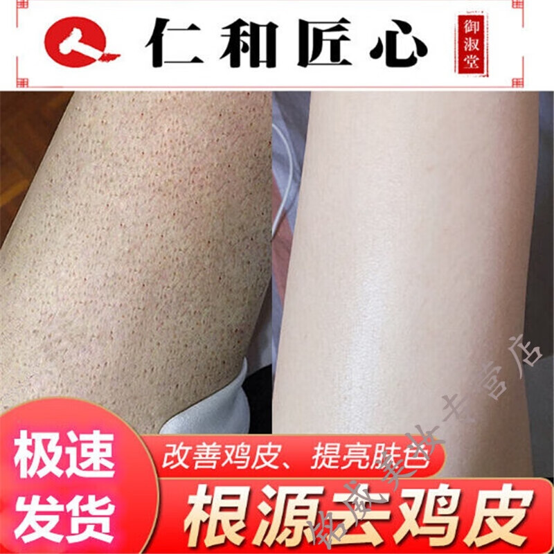 仁和鸡皮肤疙瘩去除毛囊角质化堵塞腿部手臂全身保湿美肤白身体乳非