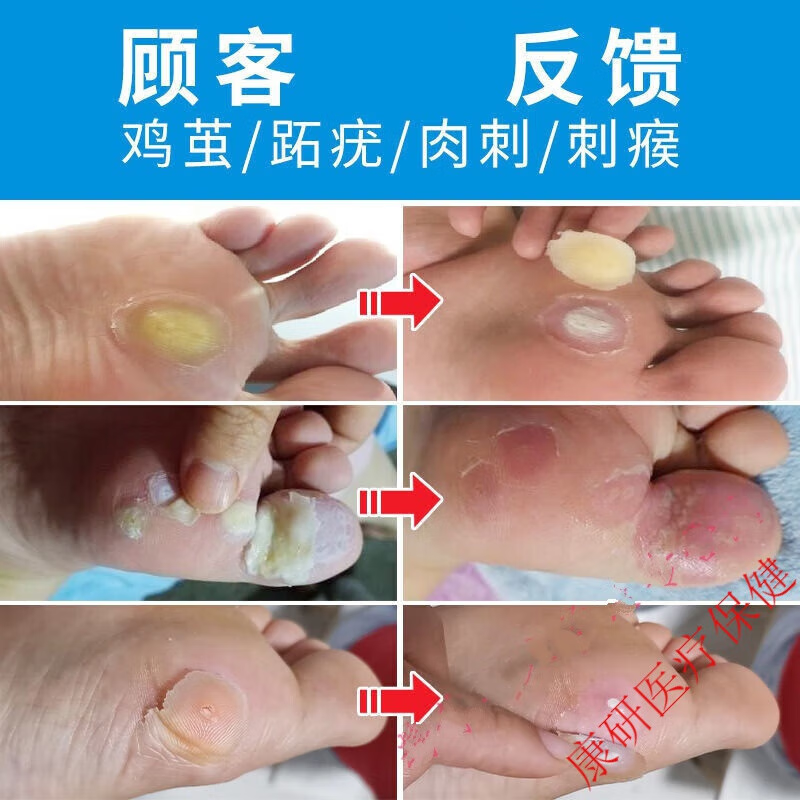 克尤液膏贴液脚根足部手部脚趾老茧脚底茧脚垫疣肉刺跖疣脚茧趾底根