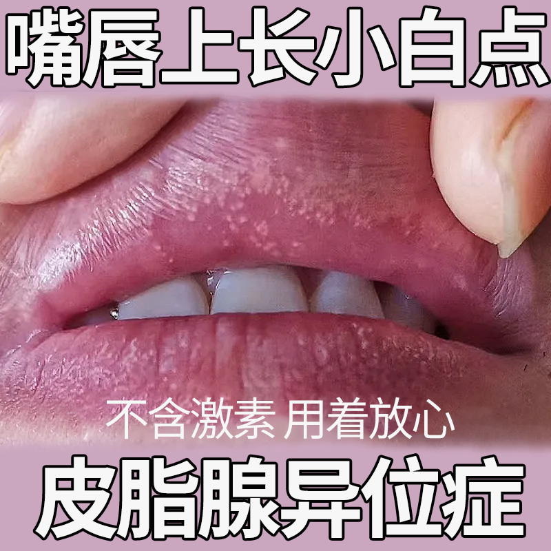 药房同售皮脂腺异位症特傚效非药监备案辅助去除嘴唇白点增生长小颗粒