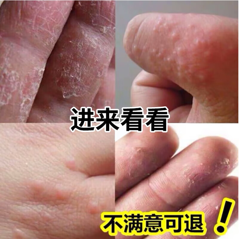 正精研康苗毒皮霸汗湿外用汗l疱小水泡手脱皮痒脚气膏水泡皮l藓体l藓