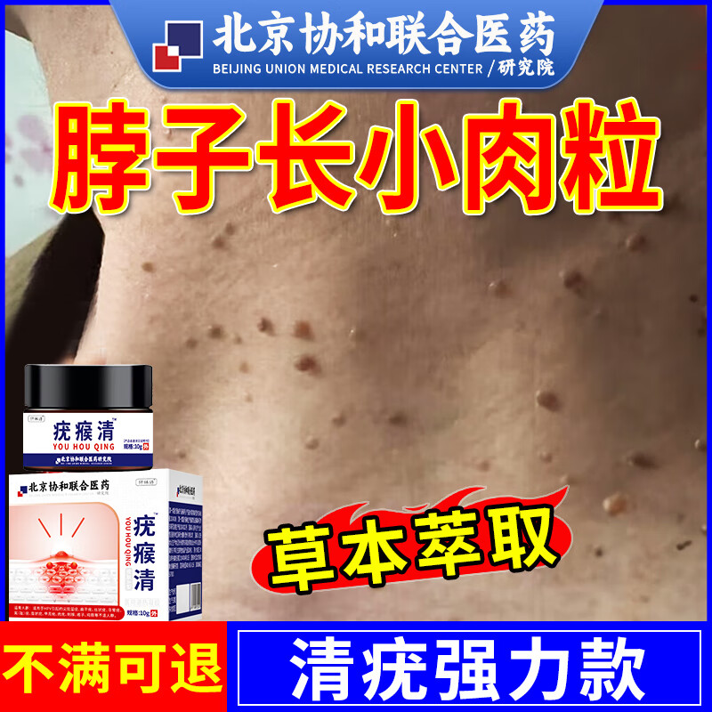 丝状疣脖子 颈部去脖子肉粒软膏颈部瘊子丝状疣专用去除器i药监备 单