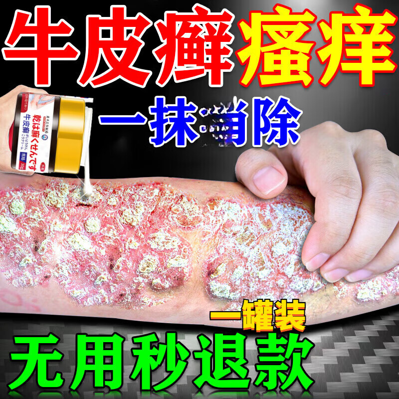 牛皮癬100%特效膏藥日本進口濕疹頭癬體癬手足蘚皮膚瘙癢止癢膏 一罐裝改善裝 官方直售