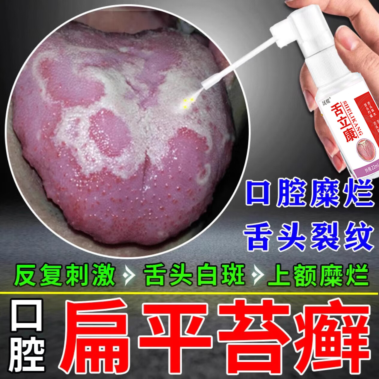 口腔扁平苔藓专用喷剂舌痛舌头白斑口腔溃疡裂糜烂炎纹烂舌头治用疗灼