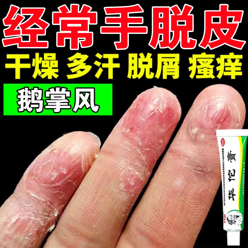 华佗膏 手癣专用药膏鹅掌风 手脱皮开裂真菌感染手上起小水泡手指缝痒
